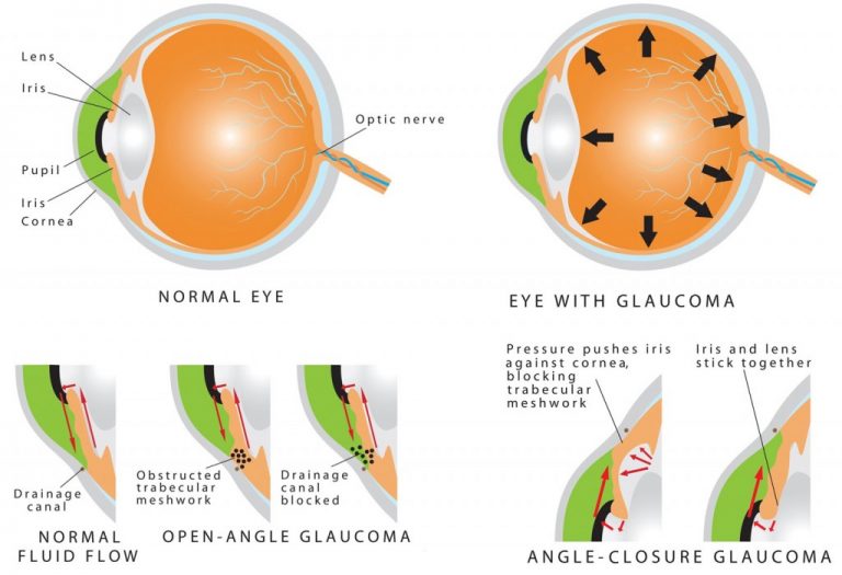 Peripheral Iridotomy Laser - South Bay Retina