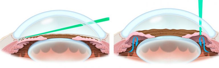 Peripheral Iridotomy Laser - South Bay Retina